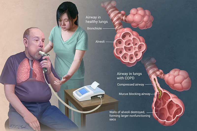 early diagnosis of copd
