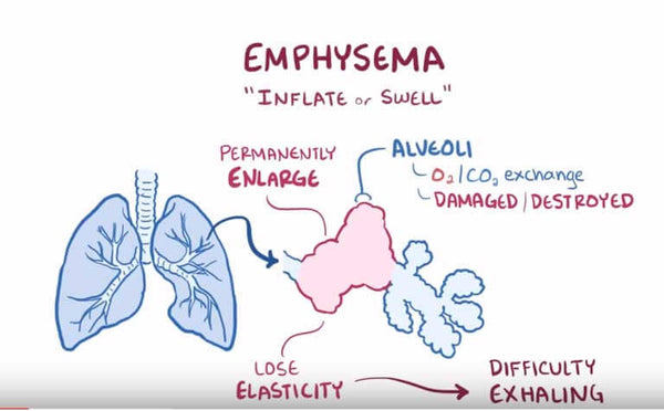 Emphysema And Oxygen Use Lungs Infographic